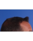 After Hair Transplant&nbsp;2 Sessions (Areas)